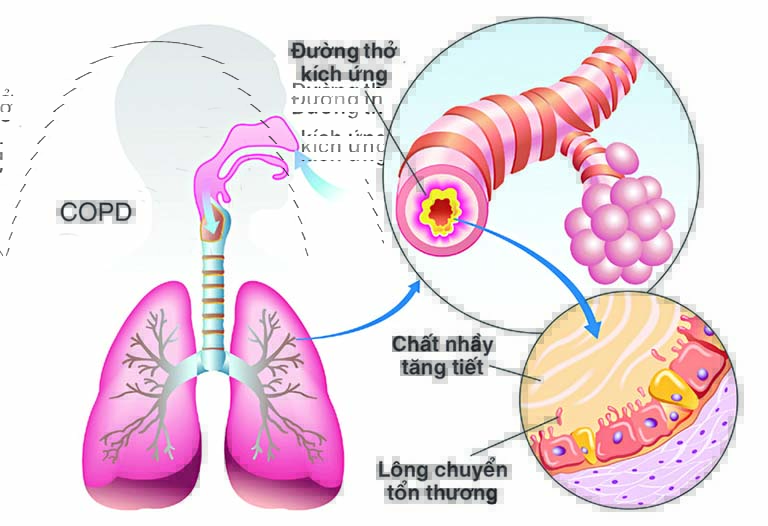 Ho Khan Là Gì? Nguyên Nhân, Biểu Hiện, Cách Chữa Trị Hiệu Quả