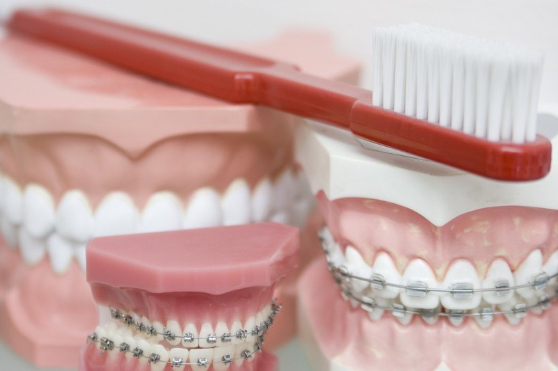 8 Signs You May Need Braces Vincent Team Orthodontics