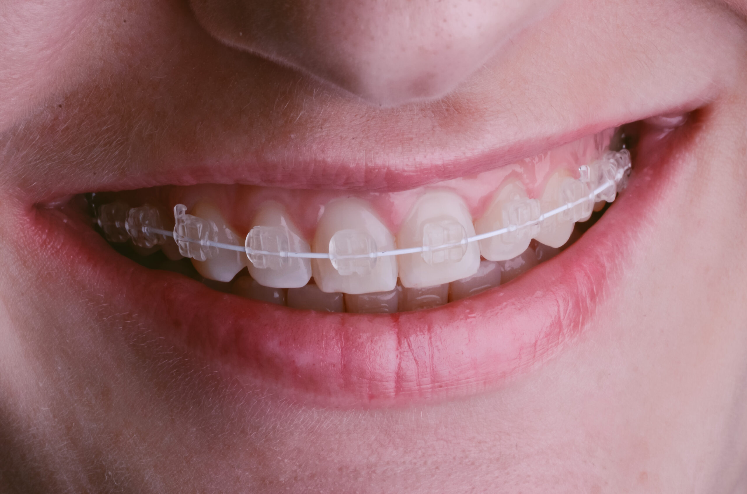 Clear Bracket Braces