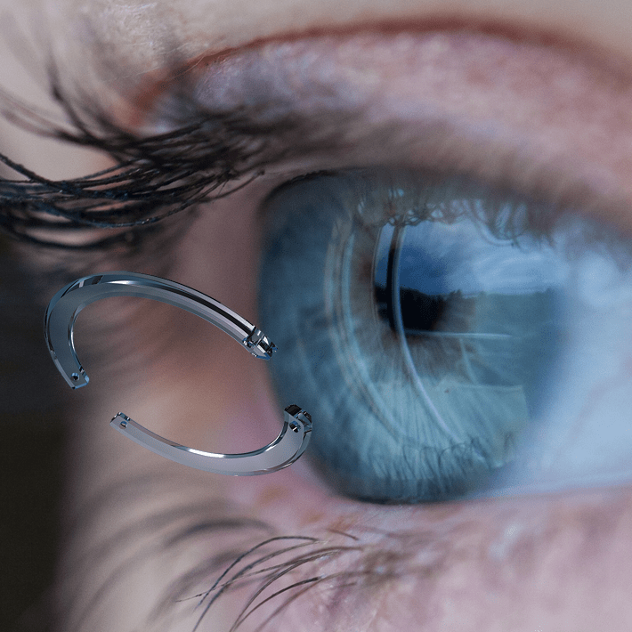 Keratoconus VIP Laser Eye Center