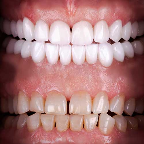 How Long Do Porcelain Veneers Last? The Answer May Surprise You!