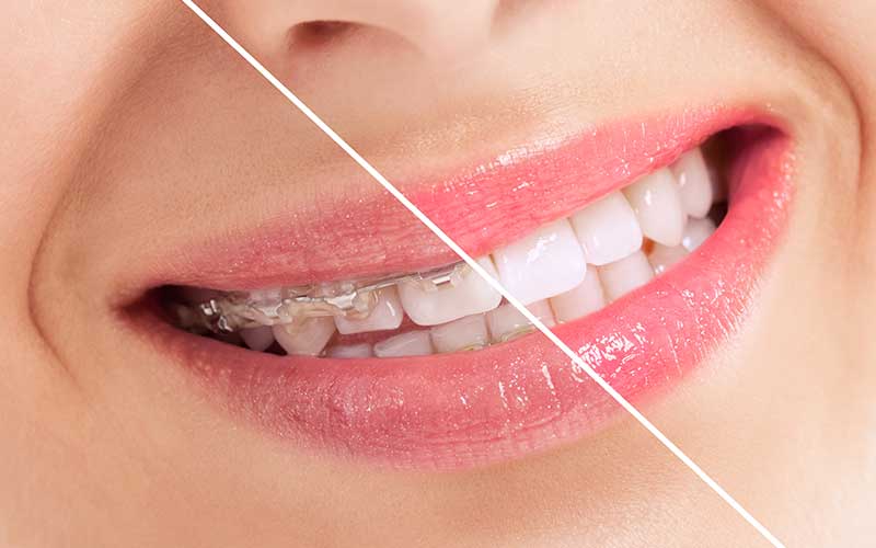 Do Veneers For Crooked Teeth REALLY Work? The New Way To Fix Your Smile!