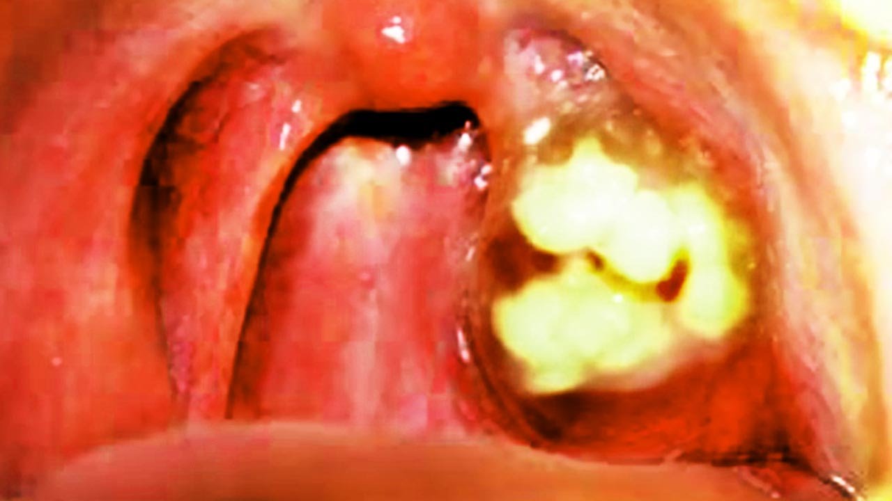 Extreme Tonsil Stone Removal Viral On The Web Now
