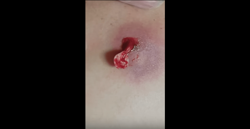 Cyst Popped At Home Viral On The Web Now