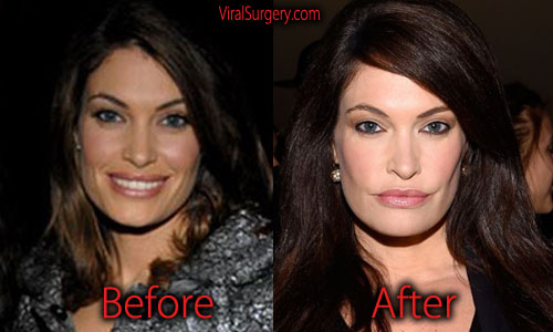Kimberly Guilfoyle Plastic Surgery Before And After Botox Pictures