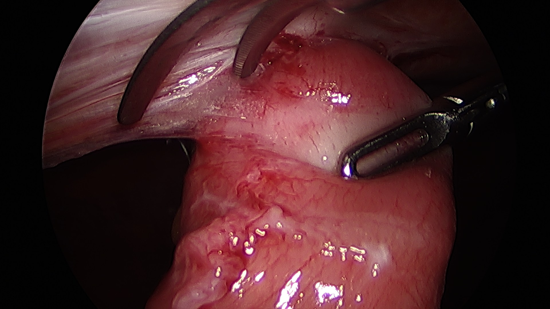 Adhesions Virginia Heartburn and Hernia Institute