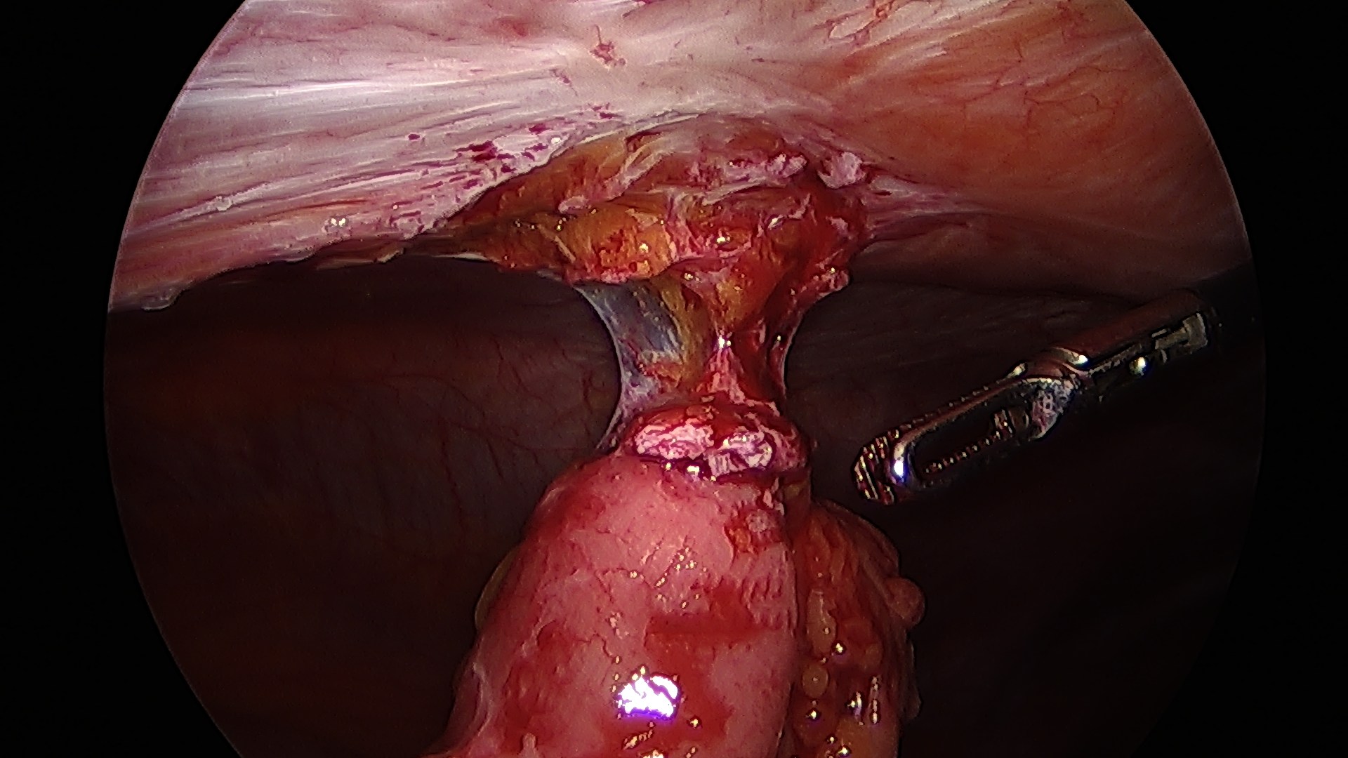 Adhesions Virginia Heartburn and Hernia Institute