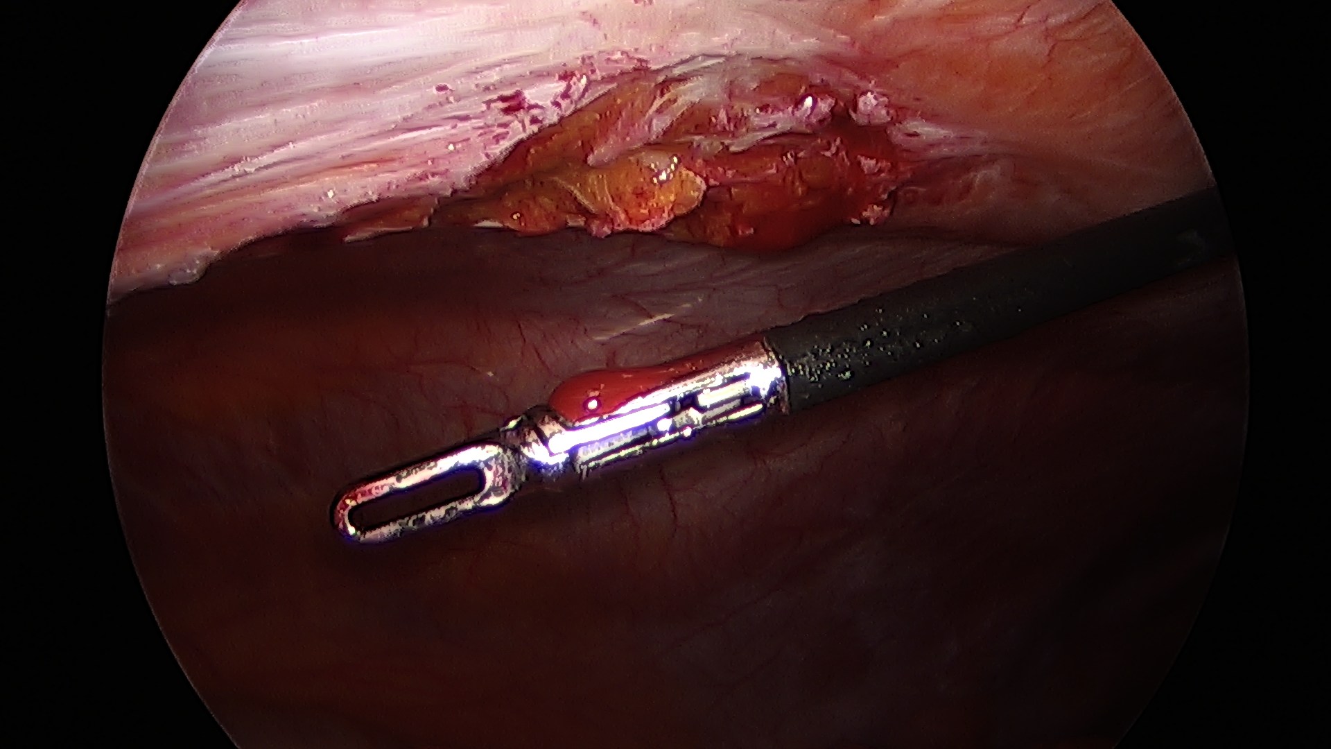 Adhesions Virginia Heartburn and Hernia Institute