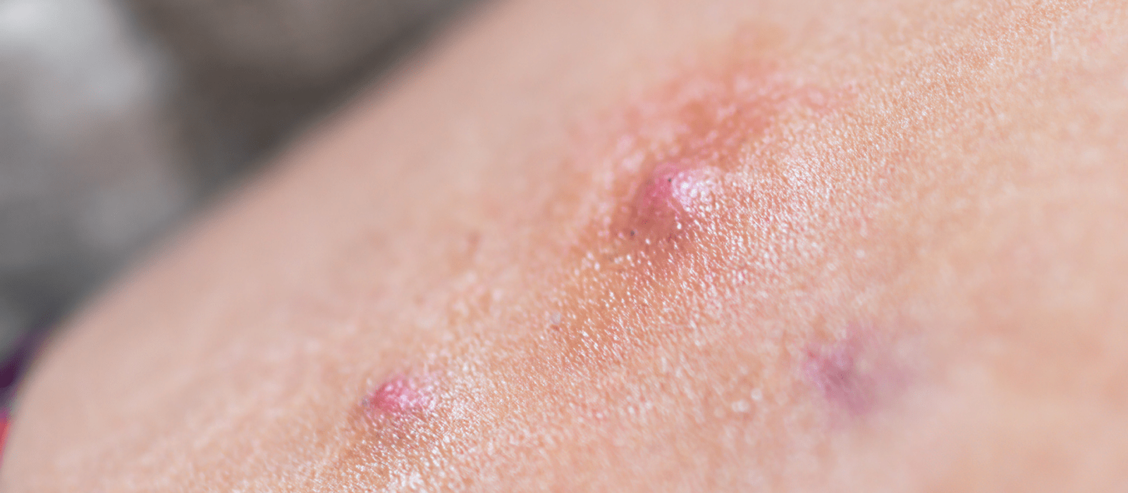 Boils Virginia Dermatology & Skin Cancer Center