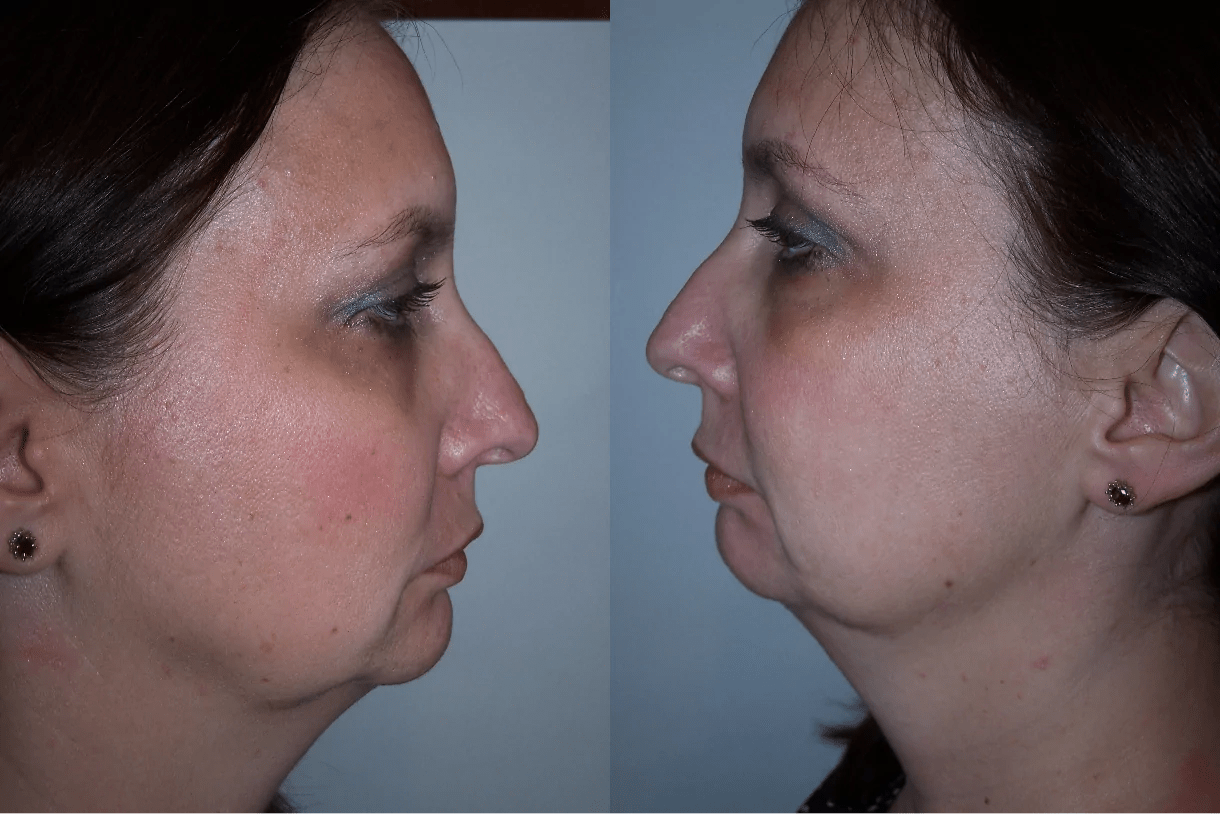 Corrective Jaw Surgery Before & After Gallery