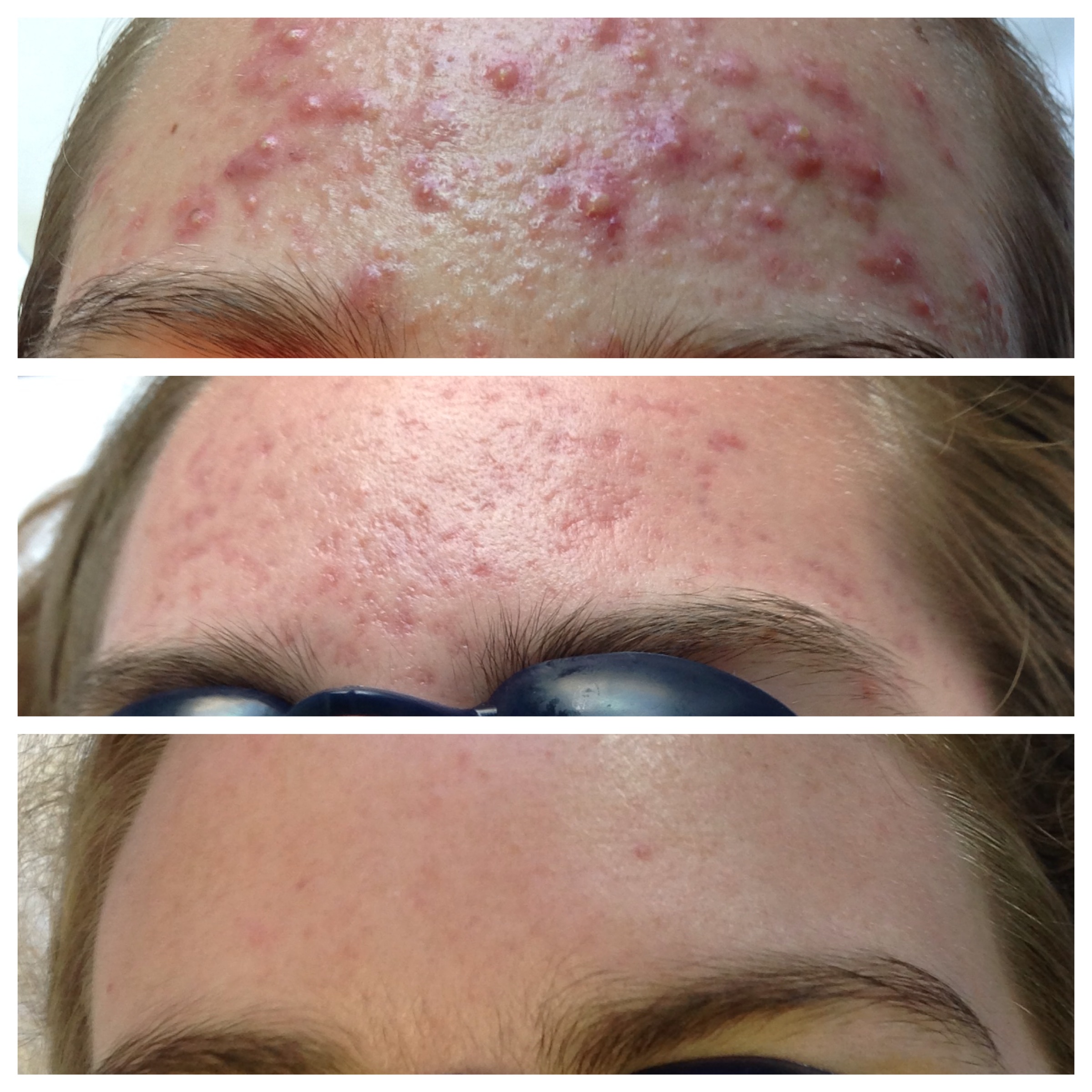 Providence Acne Clinic at Viriditas