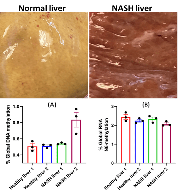 LCMS/MS Quantification of the Methylation Status of NASH Clinical Samples