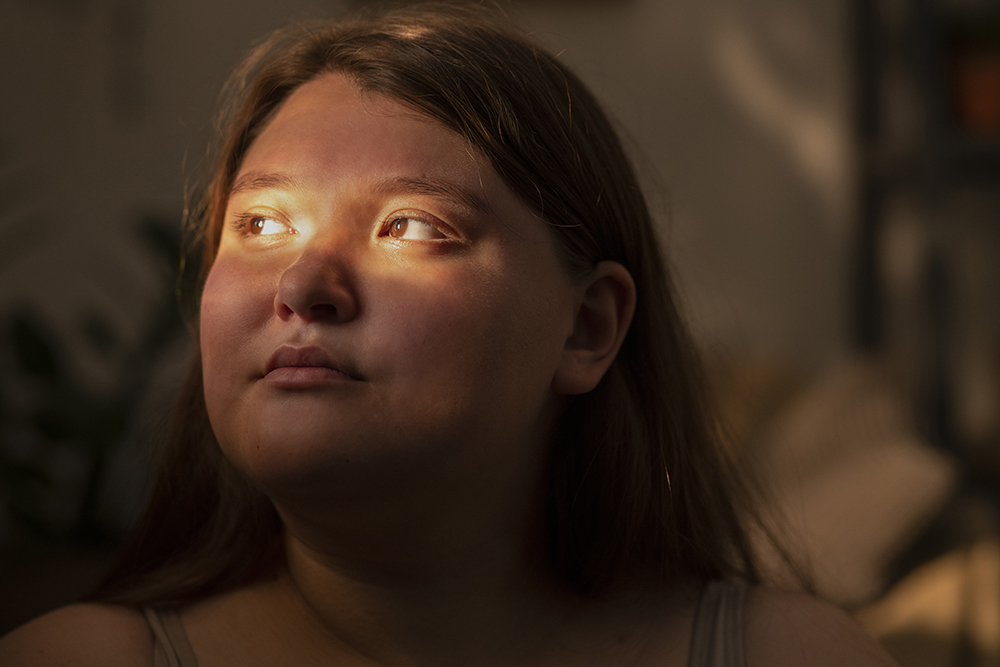 Can Your Eyes Get Sunburned? Understanding Photokeratitis Vision Care Direct