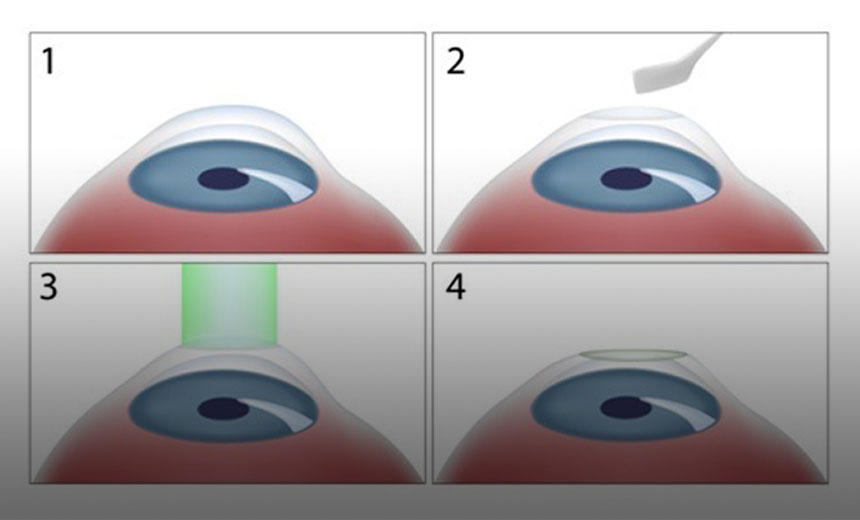 ASLA laser eye surgery procedure & recovery information