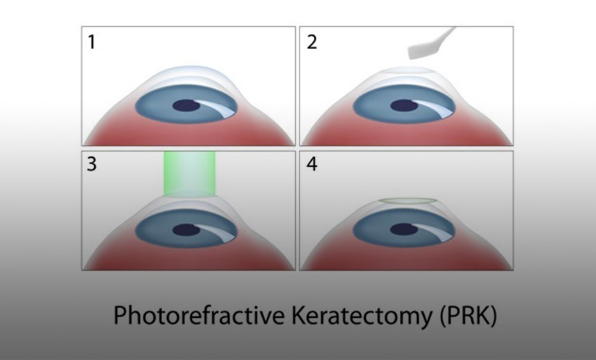 What is PRK (photorefractive keratectomy)? Vision Eye Institute