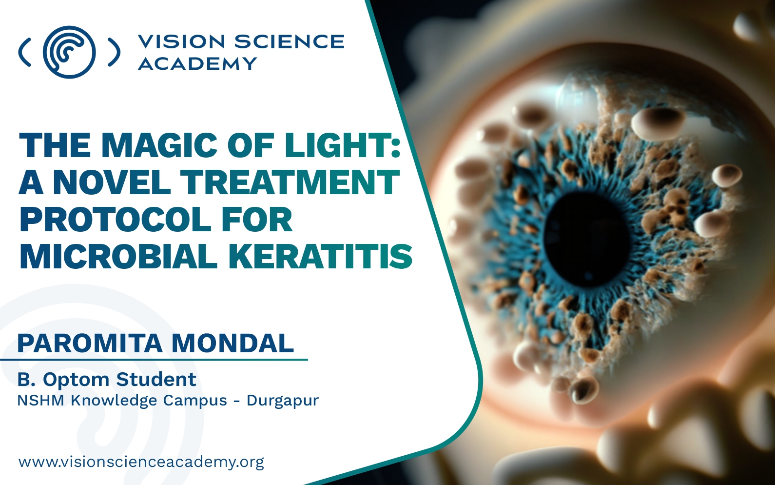 The Magic of Light A Novel Treatment Protocol for Microbial Keratitis