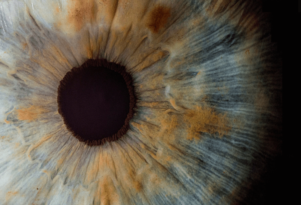 Eye Surgery Treatments inc Laser Eye Surgery, Lens Replacement