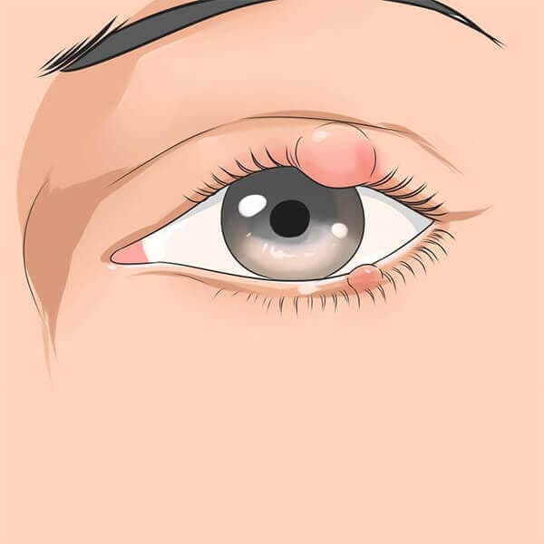 Chalazion Treatment Chalazion Surgery Chalazion Eye Treatment