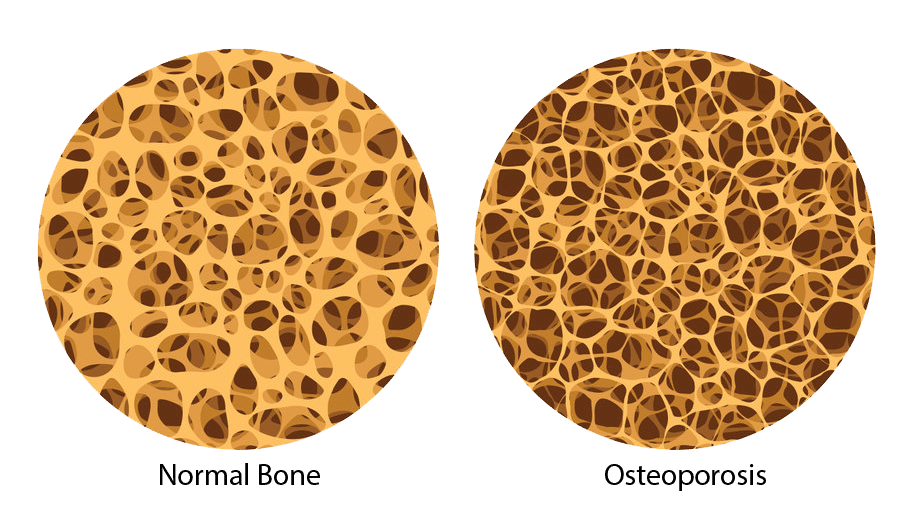 LED Light Therapy & Osteoporosis Visum Light