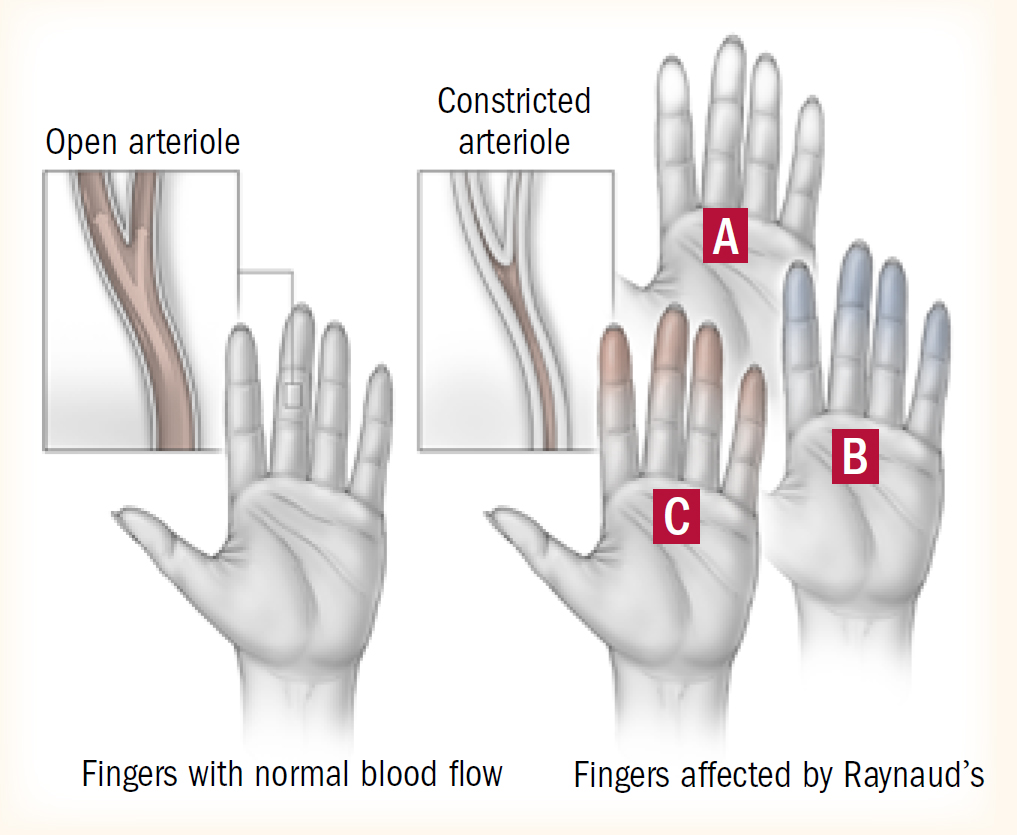 ظاهرة رينو Raynaud’s Phenomenon و دور الأرجينين كعلاج مساعد ڨيتا فارما