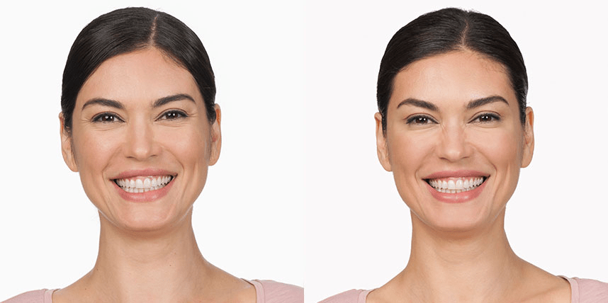 Botox Before & After Photos VITAHL Chicago