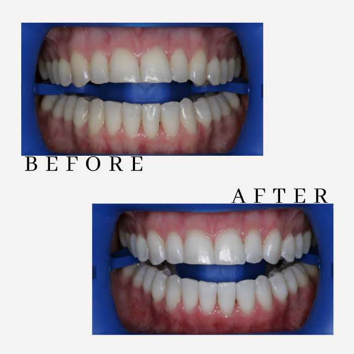 DentistGuided Teeth Whitening for the Best Results Vital Dental