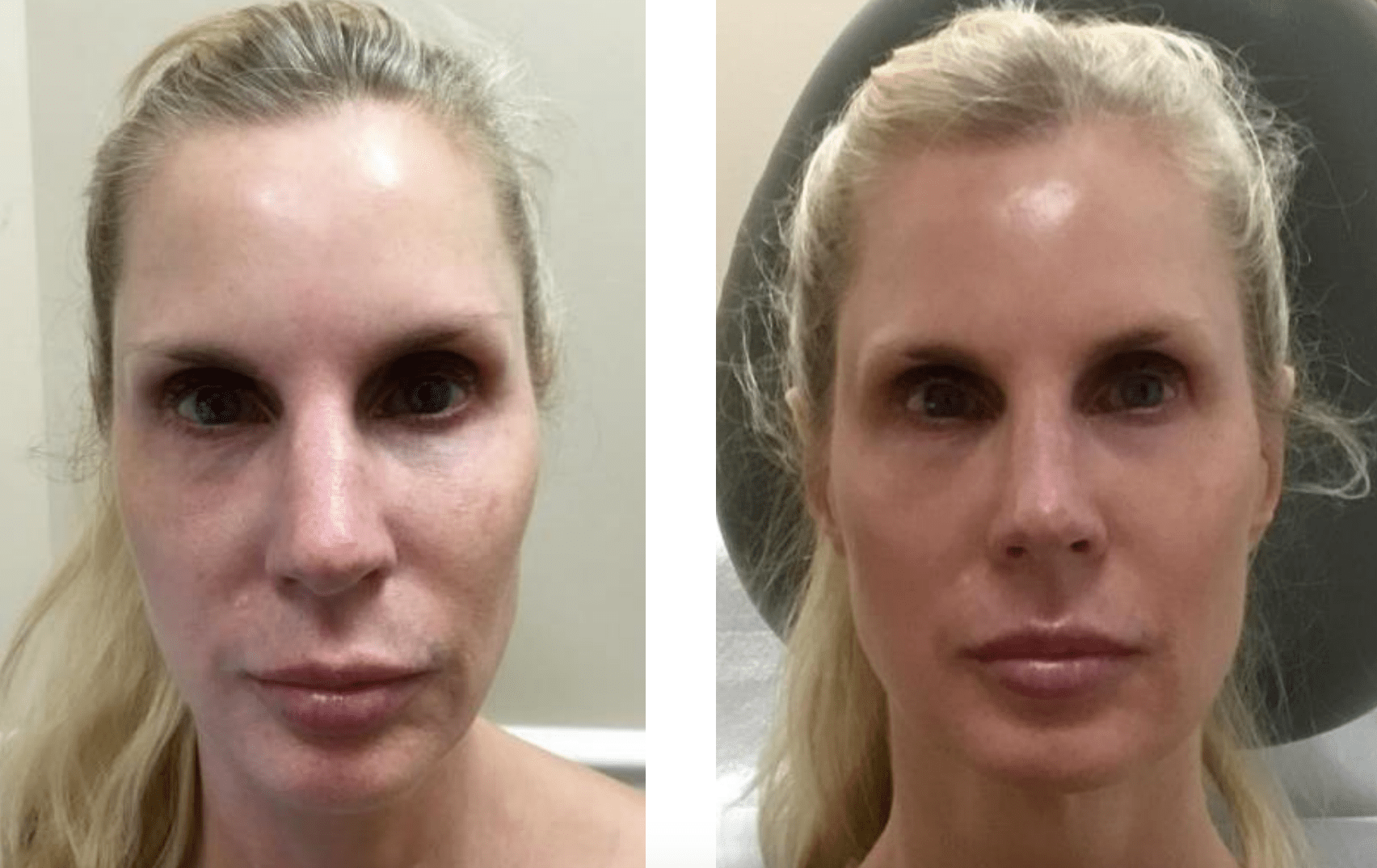 Scarlet RF VitalityMD Toronto