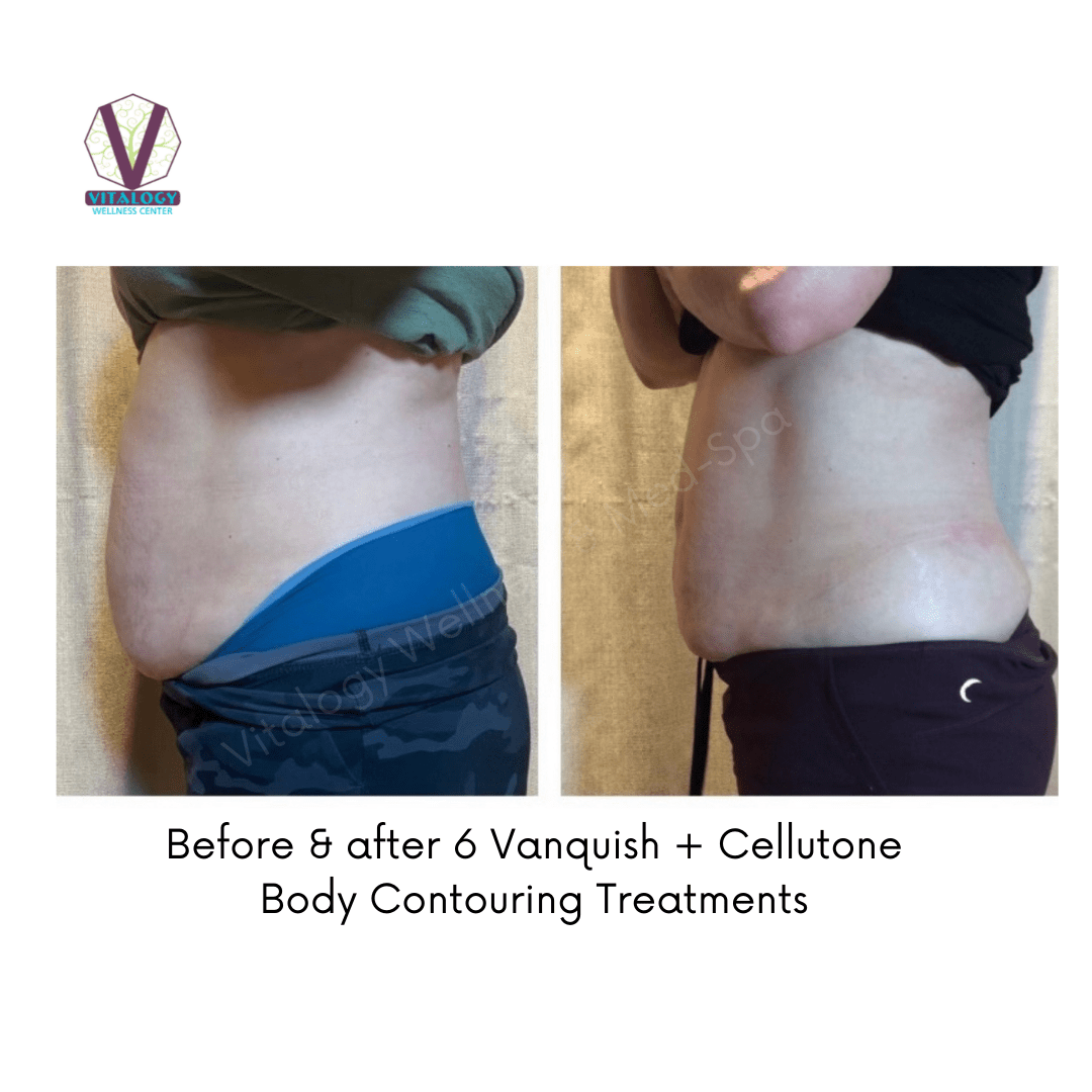 Vanquish ME Body Contouring Vitalogy Wellness Center