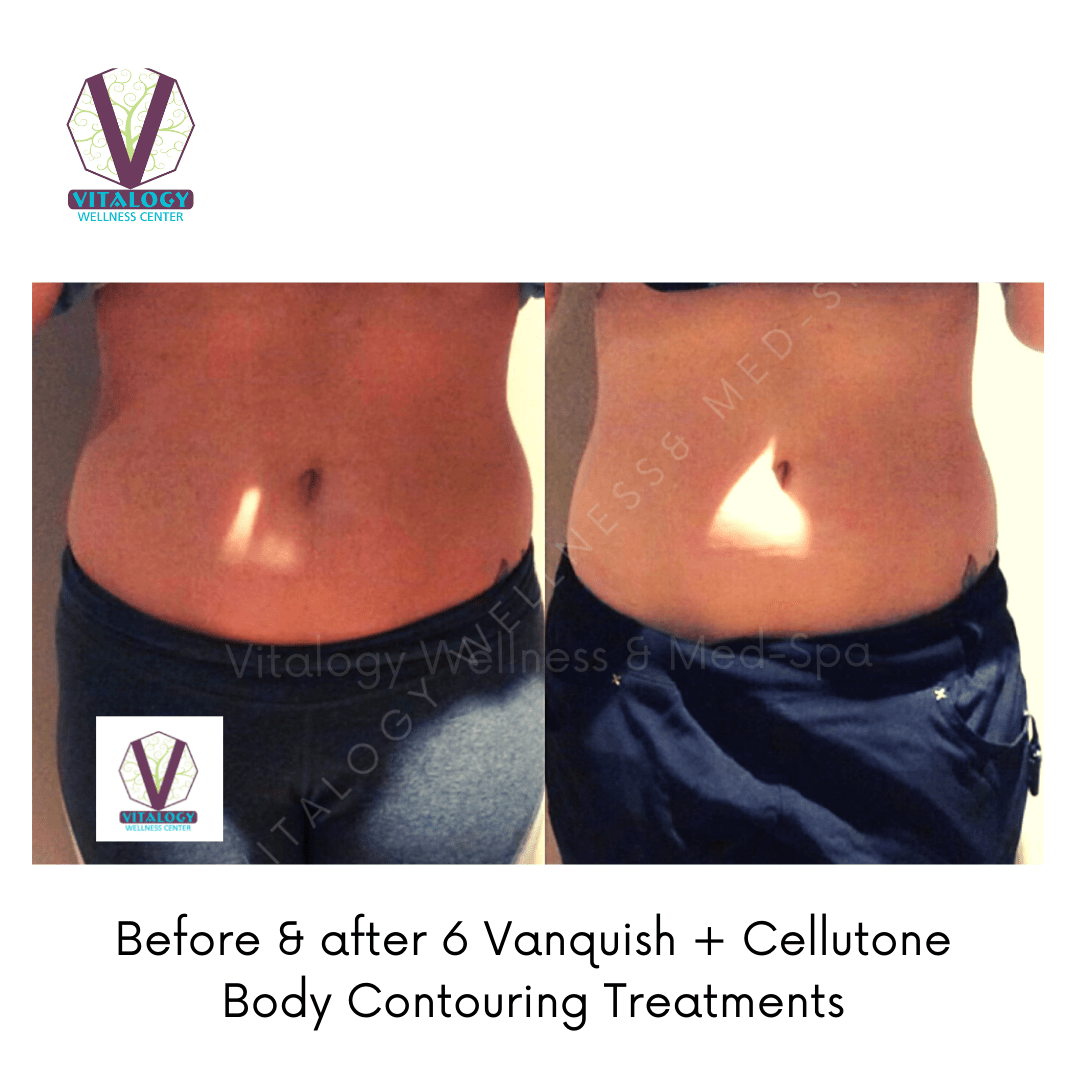 Cellutone To Treat Cellulite Vitalogy Wellness Center