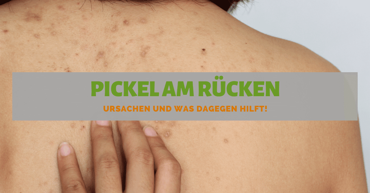 Pickel am Rücken ᐅ Ursachen und was dagegen wirklich hilft