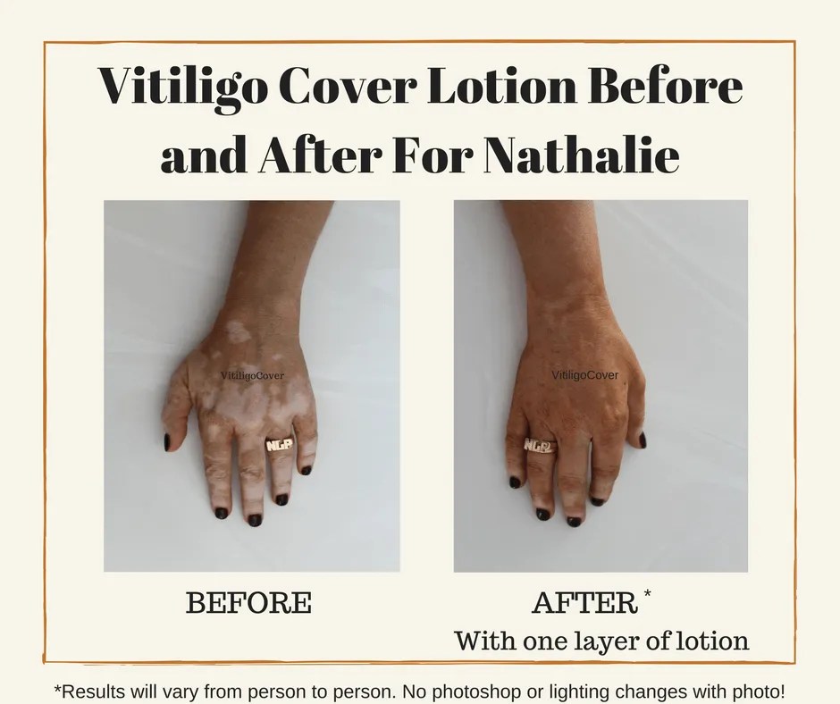 How Vitiligo Cover Differs From Store Bought Tanning Products