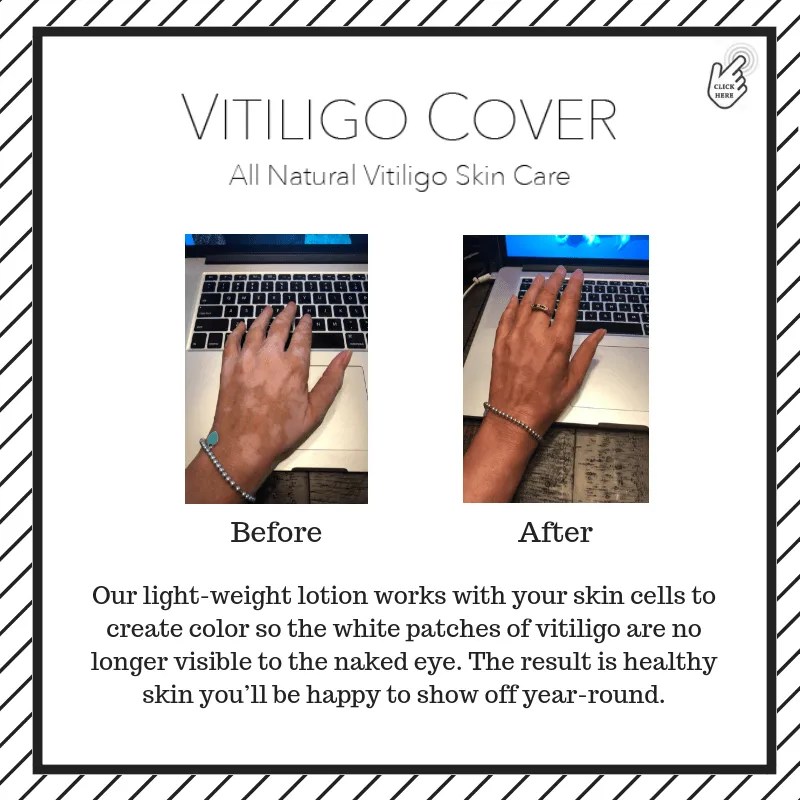 Vitiligo Cover Lotion Natural Solution to Conceal Vitiligo Patches