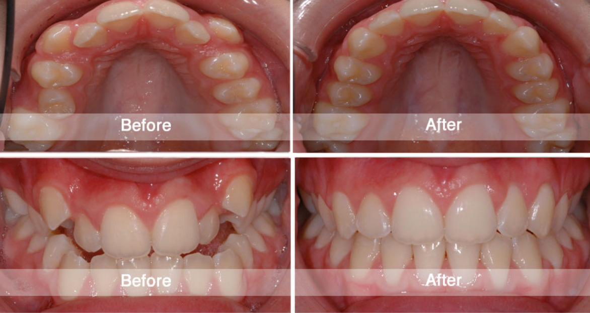 Before and After Viva Orthodontics