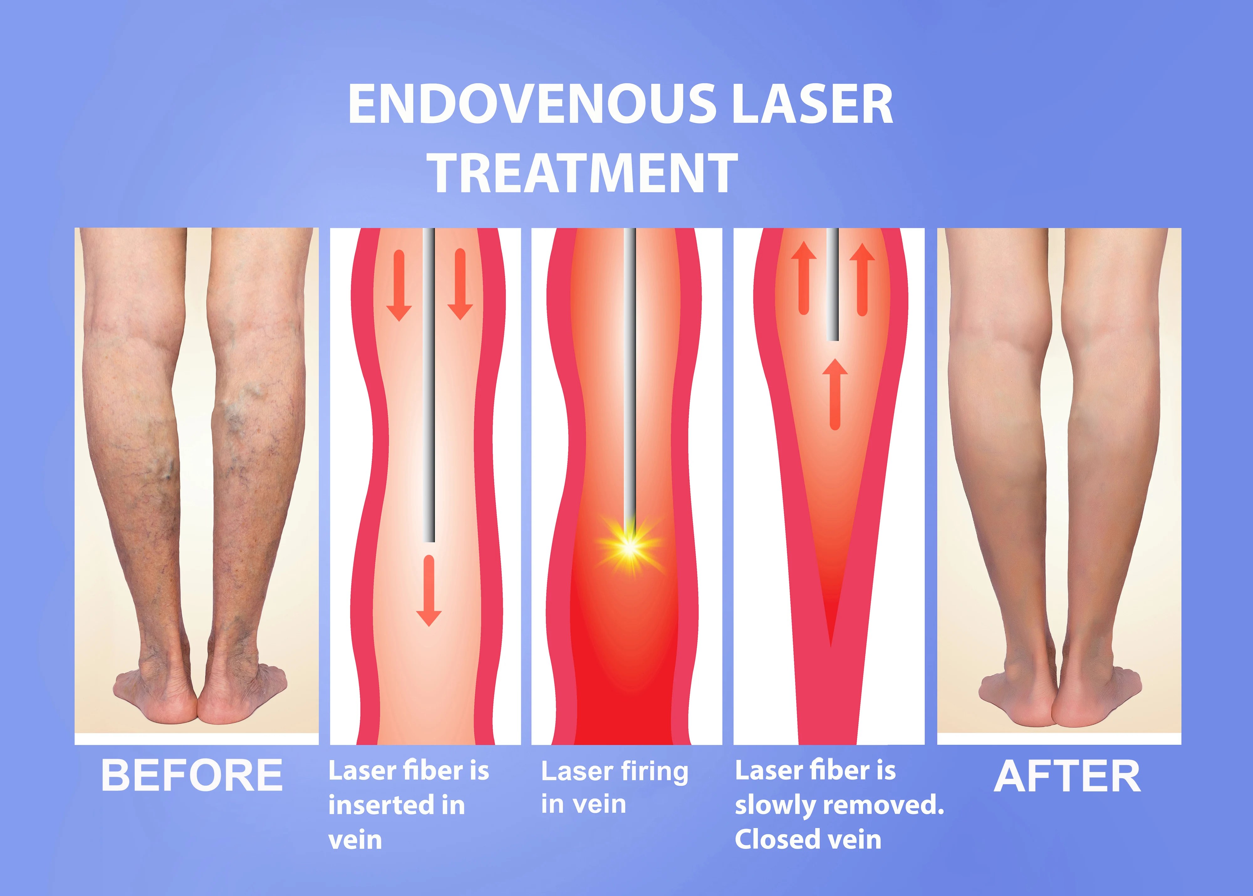 Varicose Veins Treatment Before And After