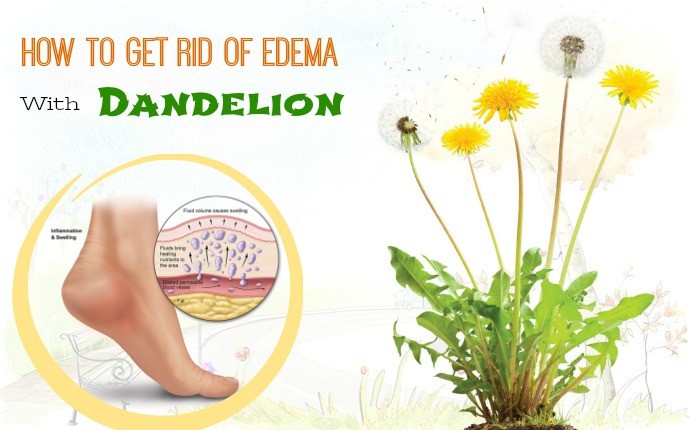 19 Tips How To Get Rid Of Edema In Legs Fast And Naturally page 2