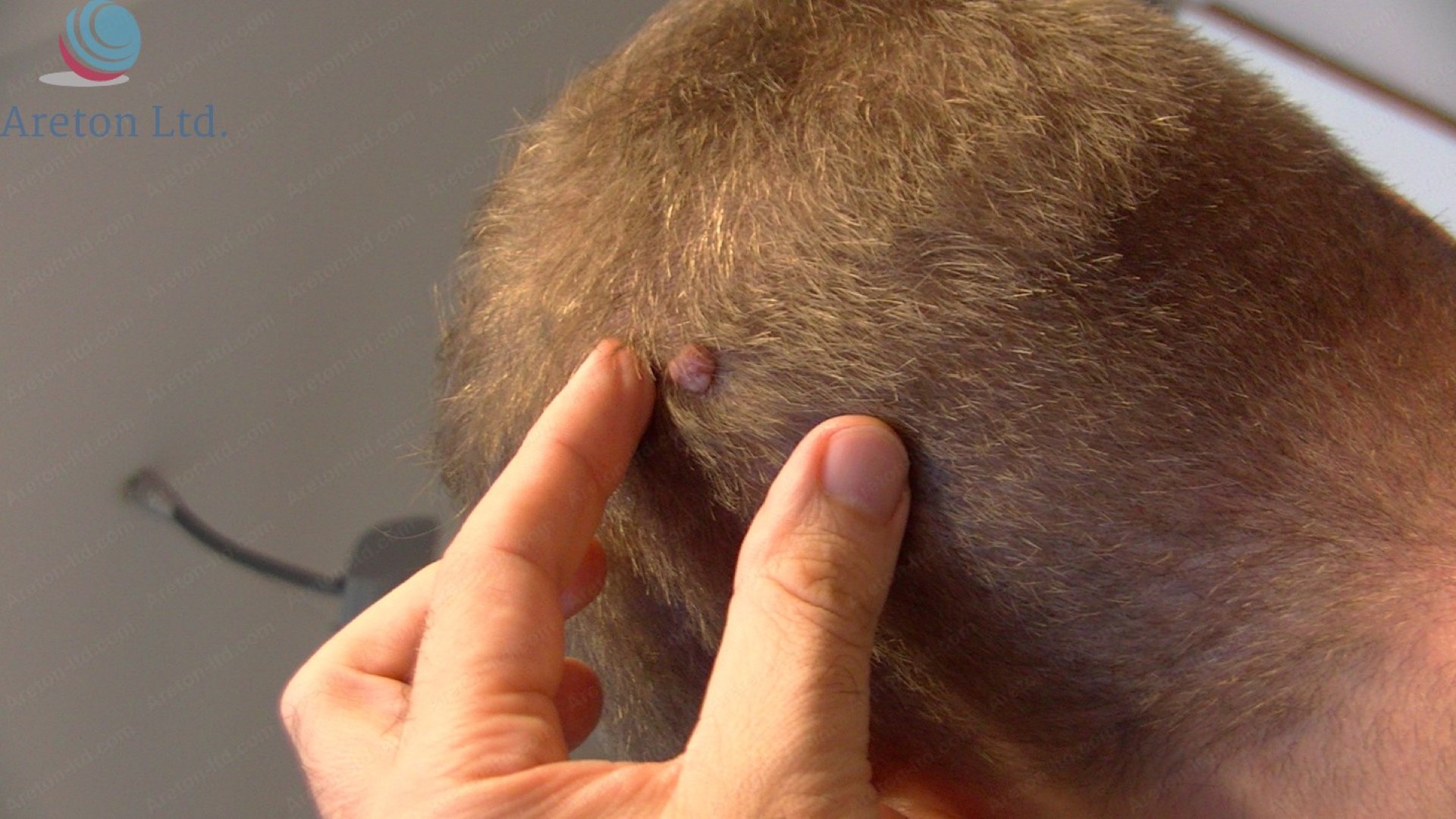 Scalp Mole Removal Case Study VoltaicPlasma Areton LTD