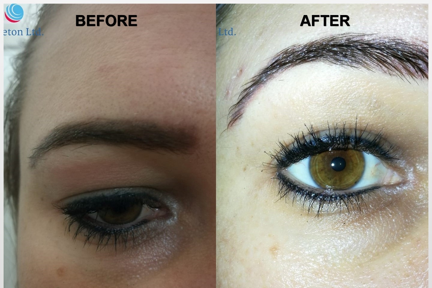 Upper and Lower Eyelid Lift, Chicken Pox Scar Removal VoltaicPlasma Areton LTD