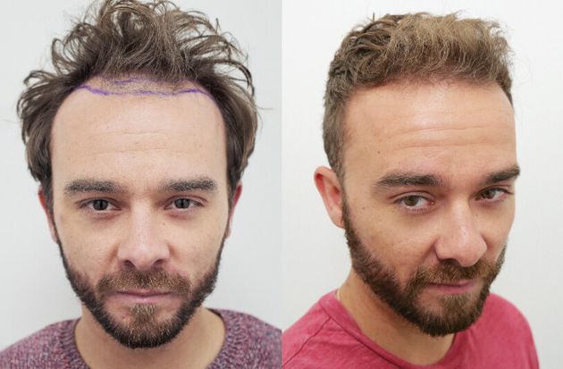Celebrities With Hair Transplants