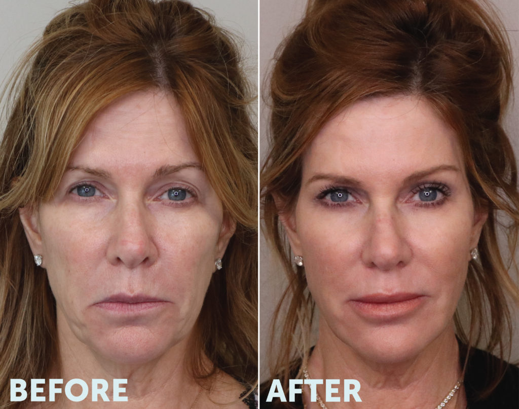 3 Vector Lifttreatment V Soft Lift