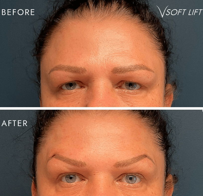 BrowLifttreatment V Soft Lift