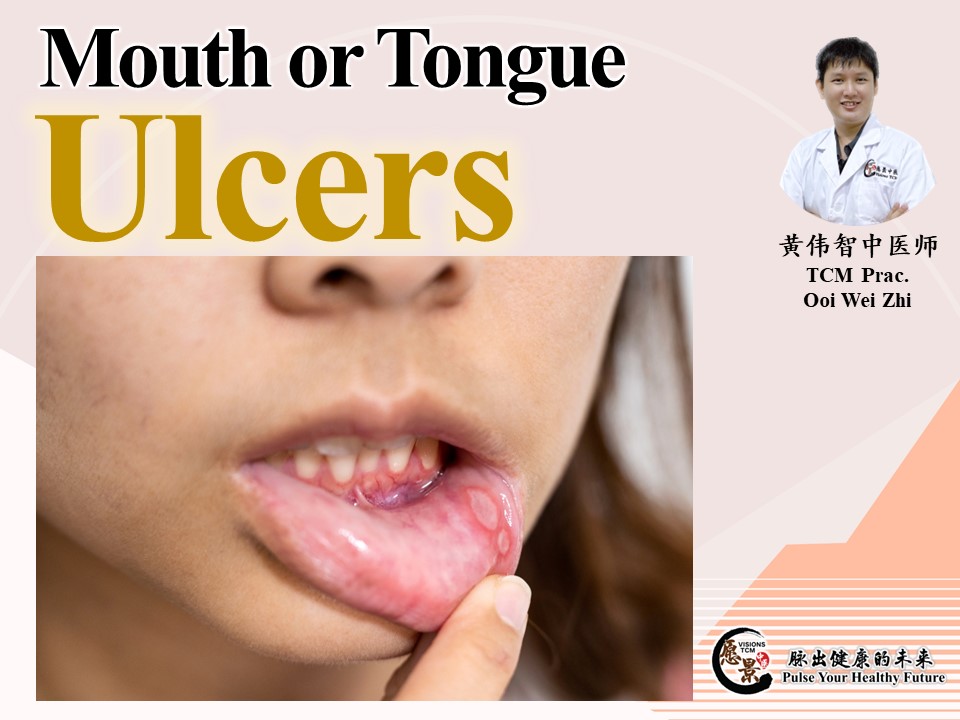 What to do if you often get ulcers in your mouth and tongue ? 愿景中医