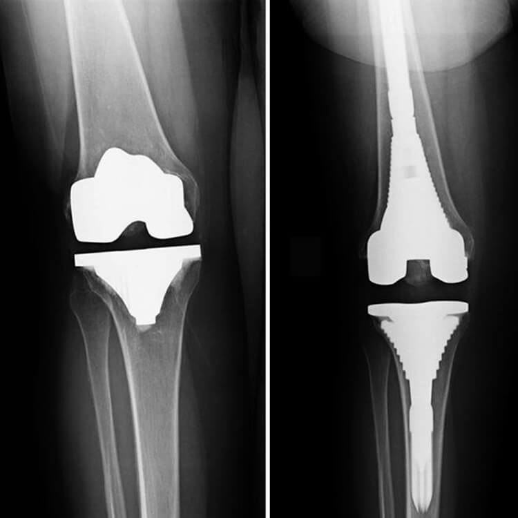 Colorado Hip & Knee Replacement Injury Lawyer McLaughlin Law Firm
