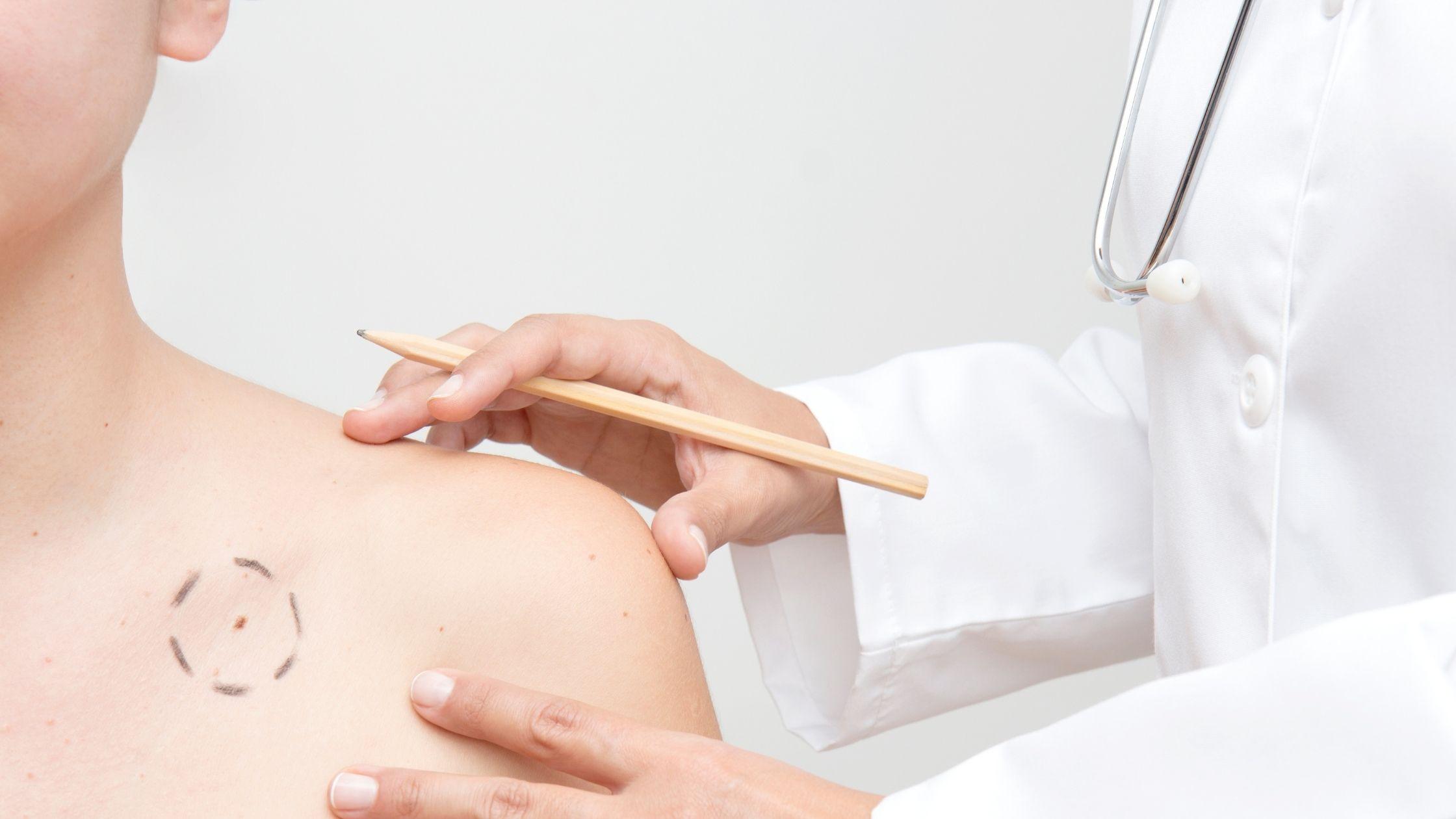 Best Dermatologist for Mohs Surgery Waccamaw Dermatology