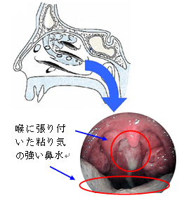 後鼻漏症状声かすれる: 後鼻漏 吐き出す – AFERRW