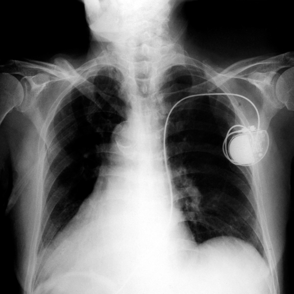 Pacemaker Powered by Heartbeat