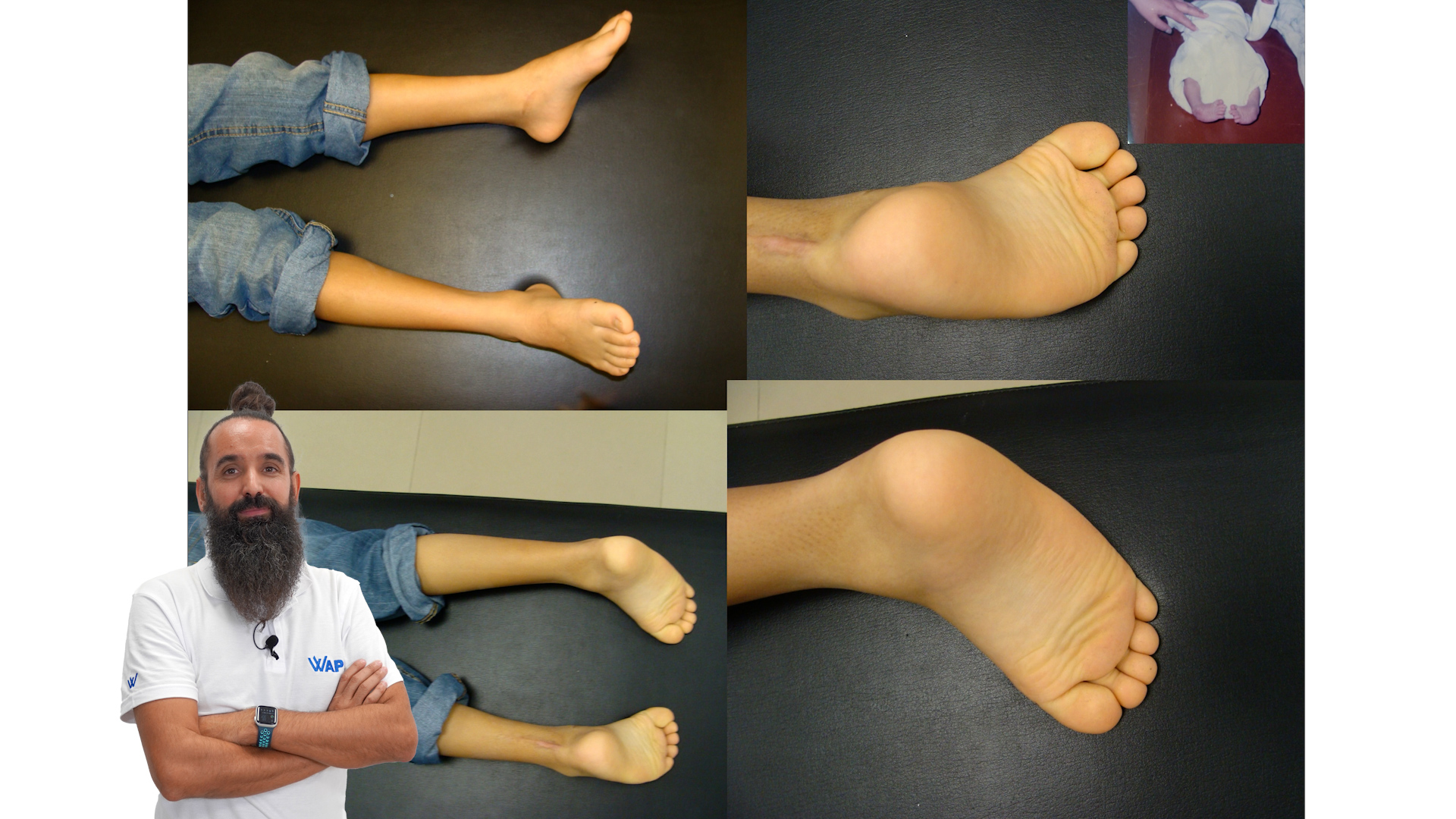 CLASE CASOS CLÍNICOS DE PIE EQUINO VARO TRAS EL MÉTODO PONSETI WAPS