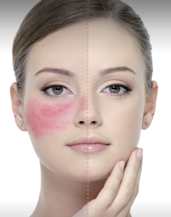 Rosacea Skin Redness Laser Treatment Belfast