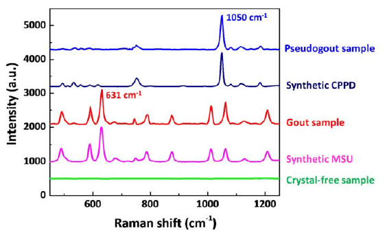 Diagnosing Gout at PointofCare with Raman Spectroscopy Wasatch