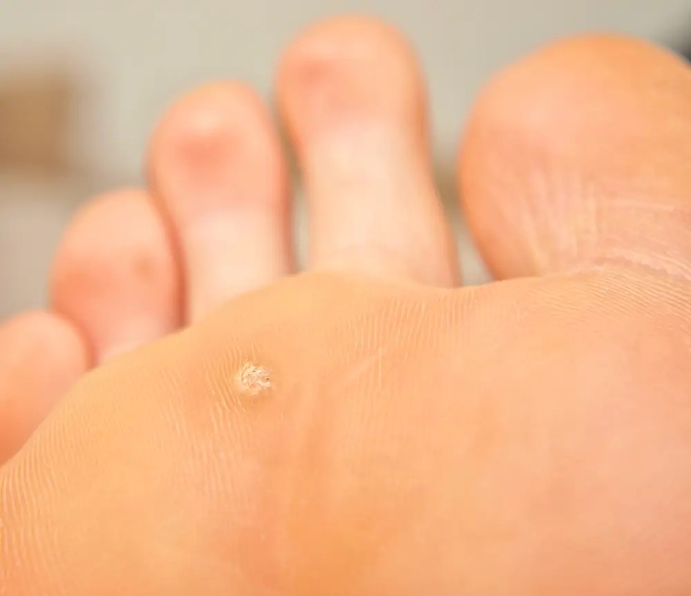 What’s the Difference Between Corns and Callus? Watsonia Podiatry