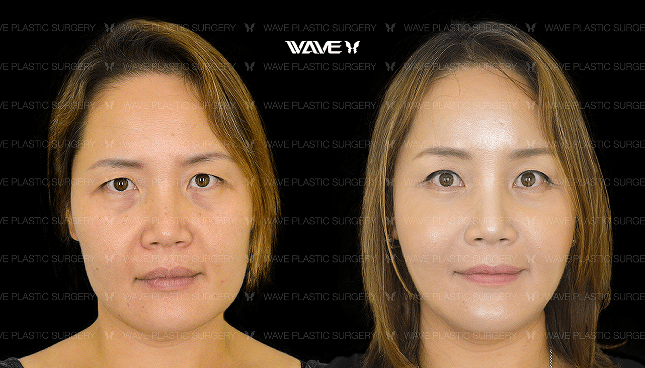 How Much Does a Facelift Cost? Wave Plastic Surgery